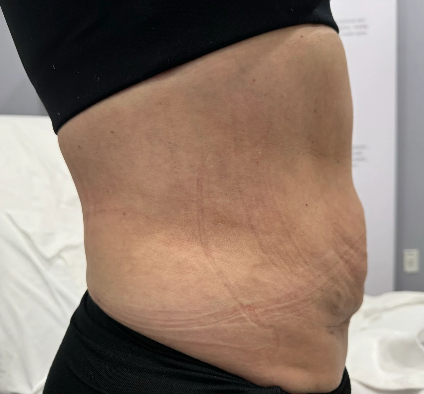 Liposuction Side Before After in Hoboken, NJ and Weehawken, NJ