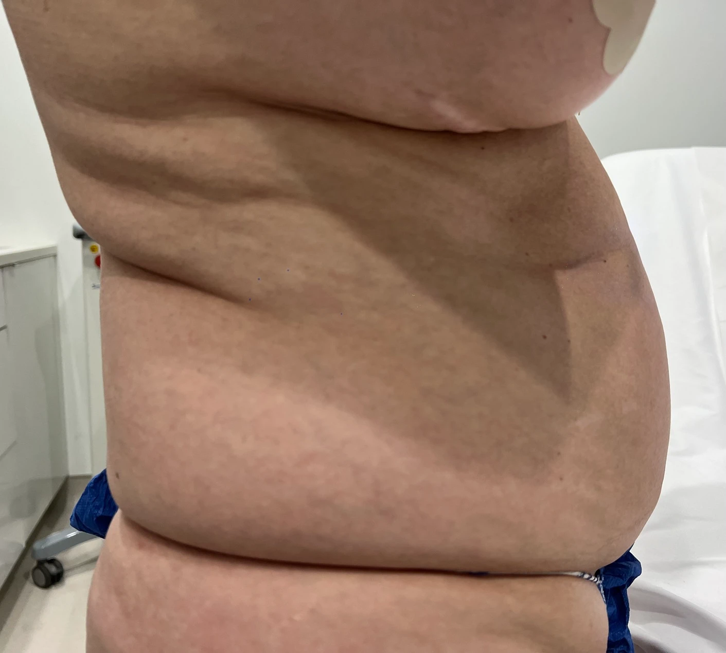 Liposuction Side Before After in Hoboken, NJ and Weehawken, NJ