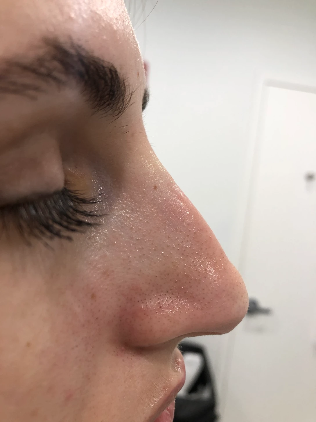 Liquid Nose Job Before After in Hoboken, NJ and Weehawken, NJ