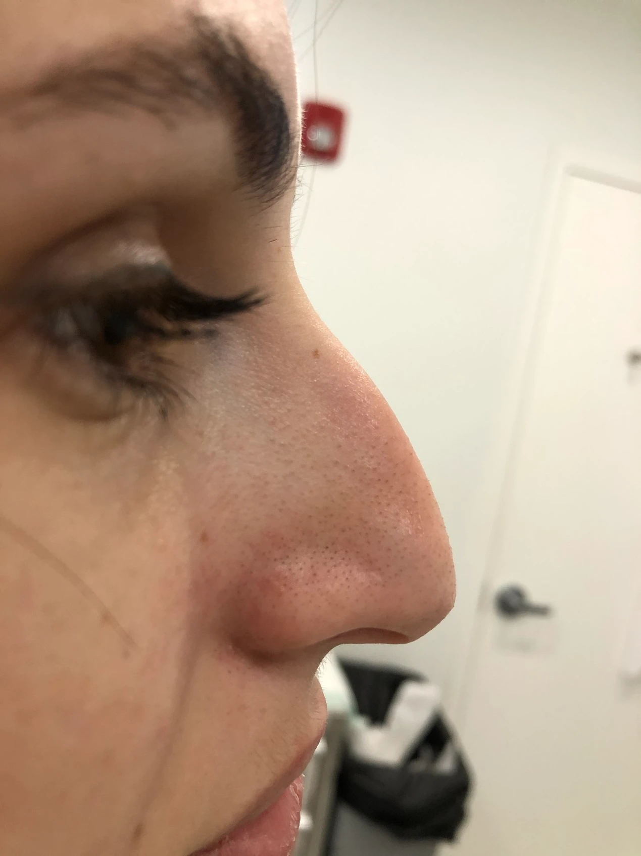 Liquid Nose Job Before After in Hoboken, NJ and Weehawken, NJ