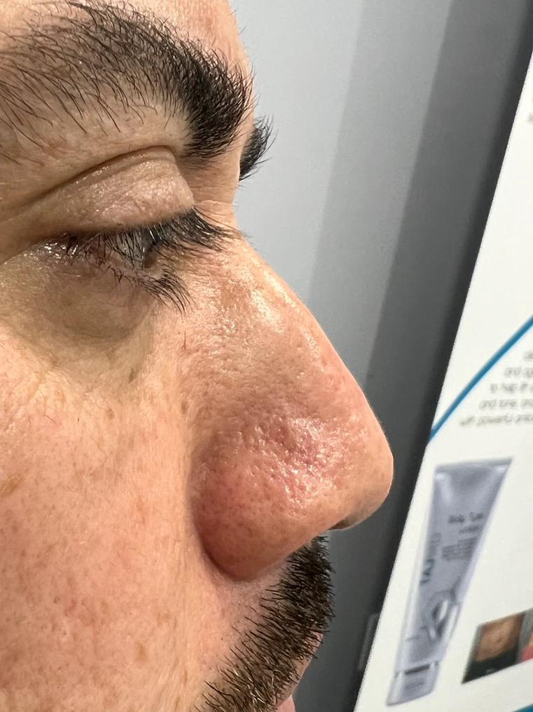 Liquid Nose Job Men Before After in Hoboken, NJ and Weehawken, NJ