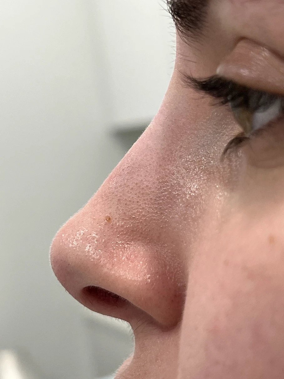 Liquid Nose Job Women Before After in Hoboken, NJ and Weehawken, NJ