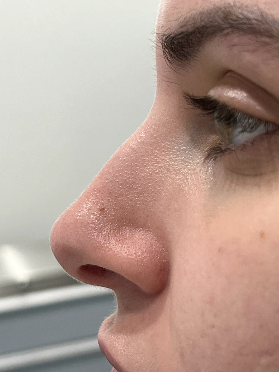 Liquid Nose Job Women Before After in Hoboken, NJ and Weehawken, NJ