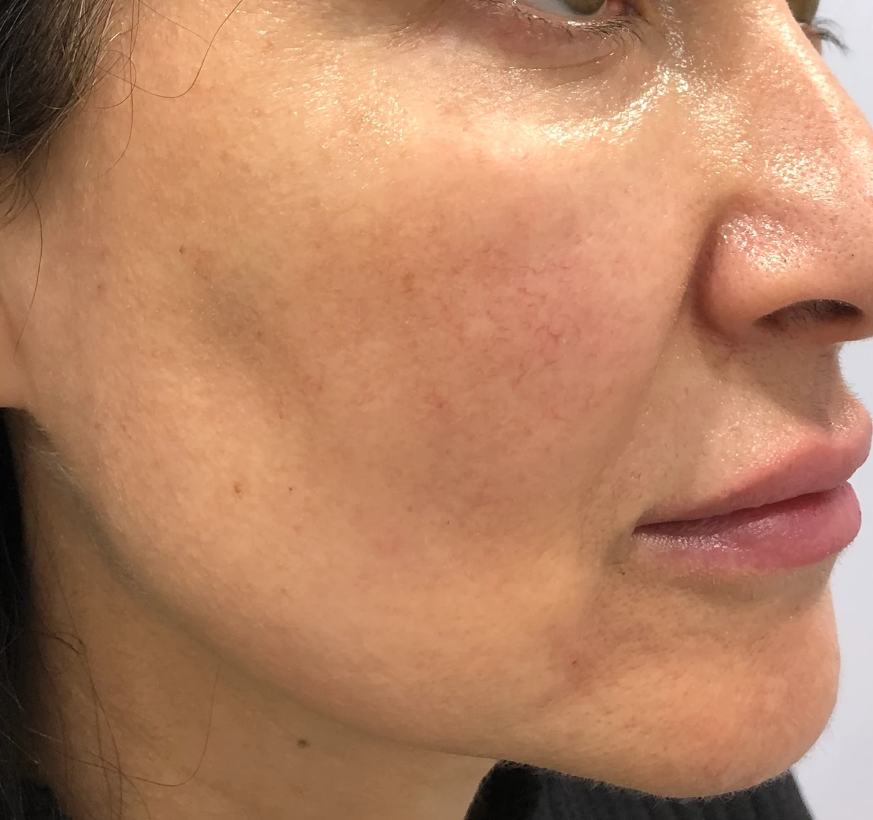 Thread Lift Right Side Face Before After in Hoboken, NJ and Weehawken, NJ