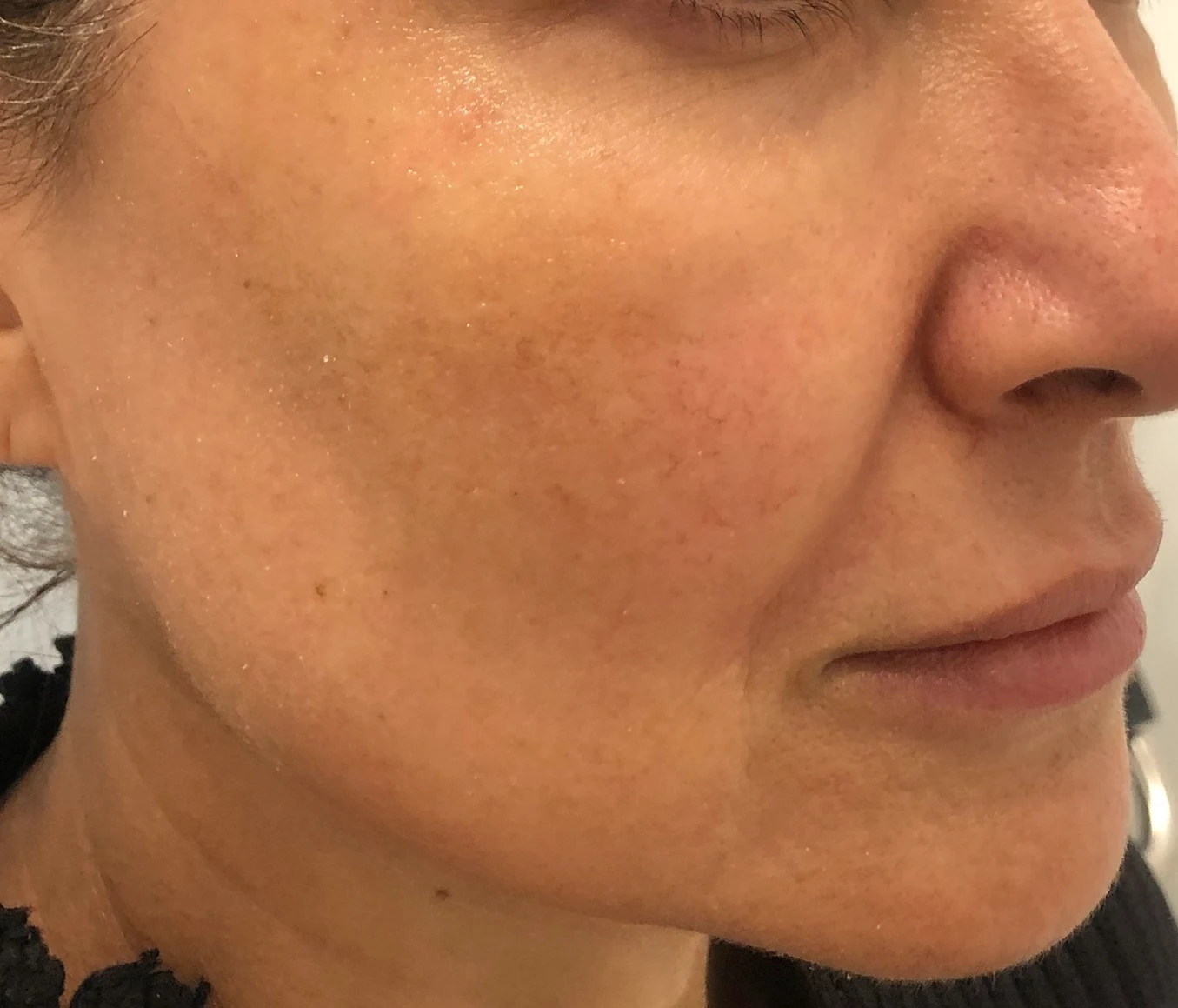 Thread Lift Right Side Face Before After in Hoboken, NJ and Weehawken, NJ