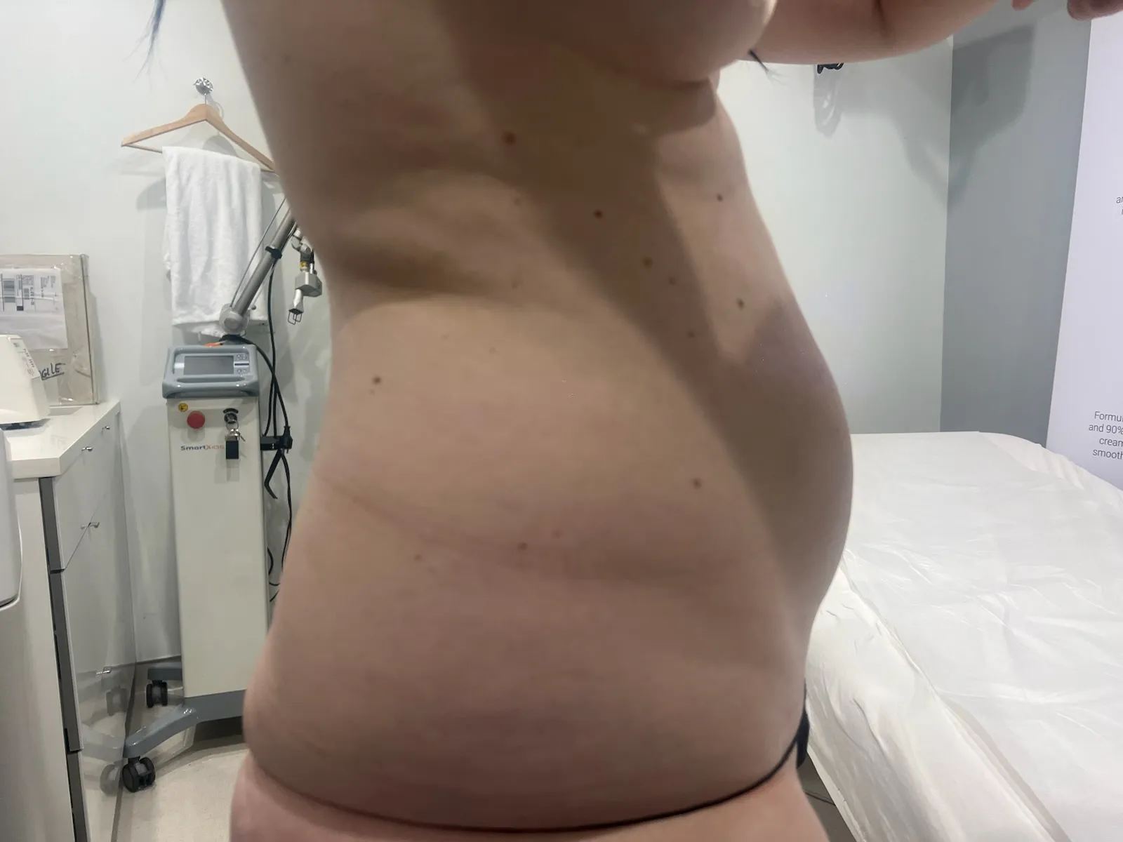 a woman's belly with a white sheet and a white towel | 1aesthetics in Hoboken, NJ and Weehawken, NJ