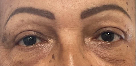 Blepharoplasty Treatment in Hoboken, NJ and Weehawken, NJ | 1aesthetics