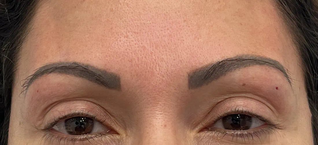 Brow Thread Lift BB After in Hoboken, NJ and Weehawken, NJ