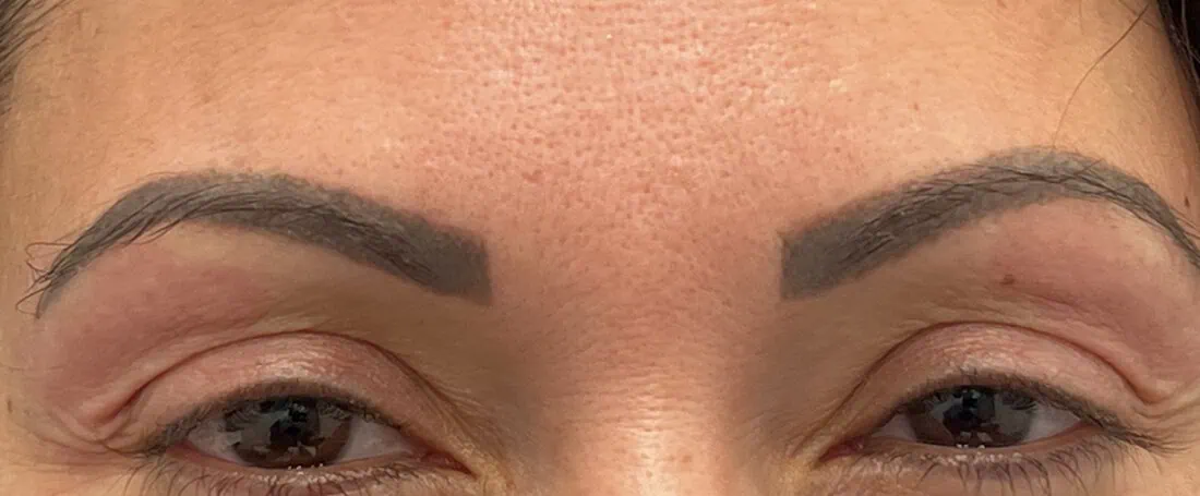 Brow Thread Lift BB Before in Hoboken, NJ and Weehawken, NJ