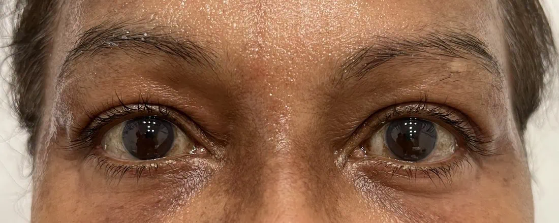 Brow Thread Lift BB After in Hoboken, NJ and Weehawken, NJ