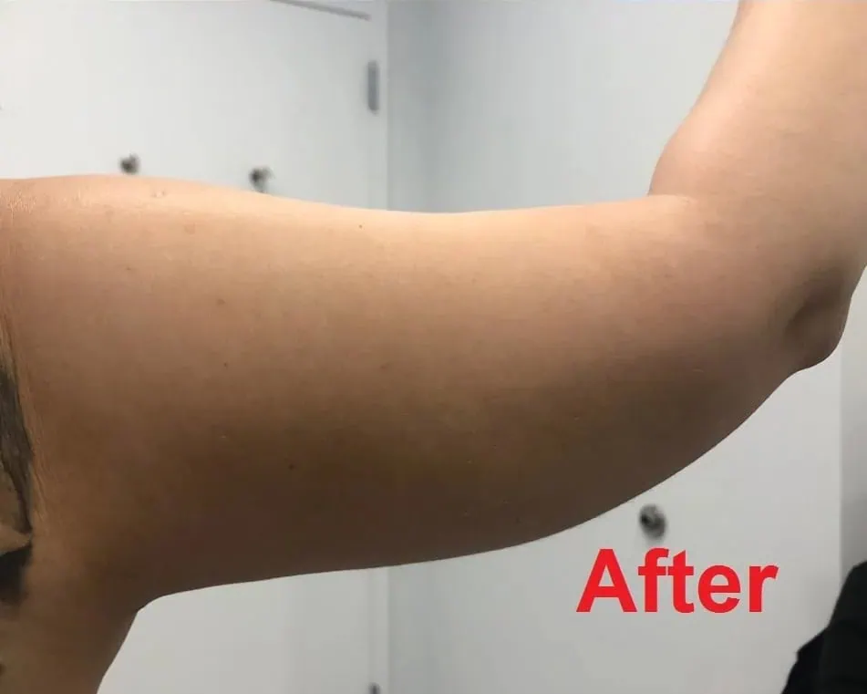 Right Arm Liposuction After in Hoboken, NJ and Weehawken, NJ