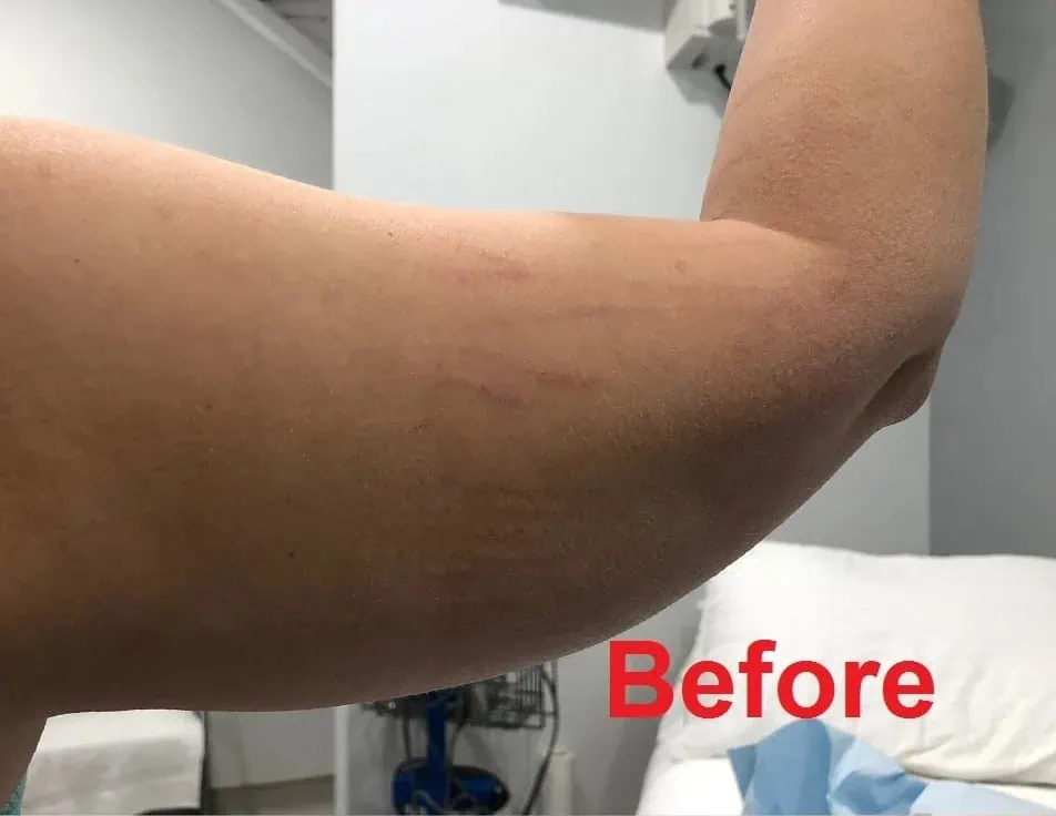 Right Arm Liposuction Before & After in Hoboken, NJ and Weehawken, NJ