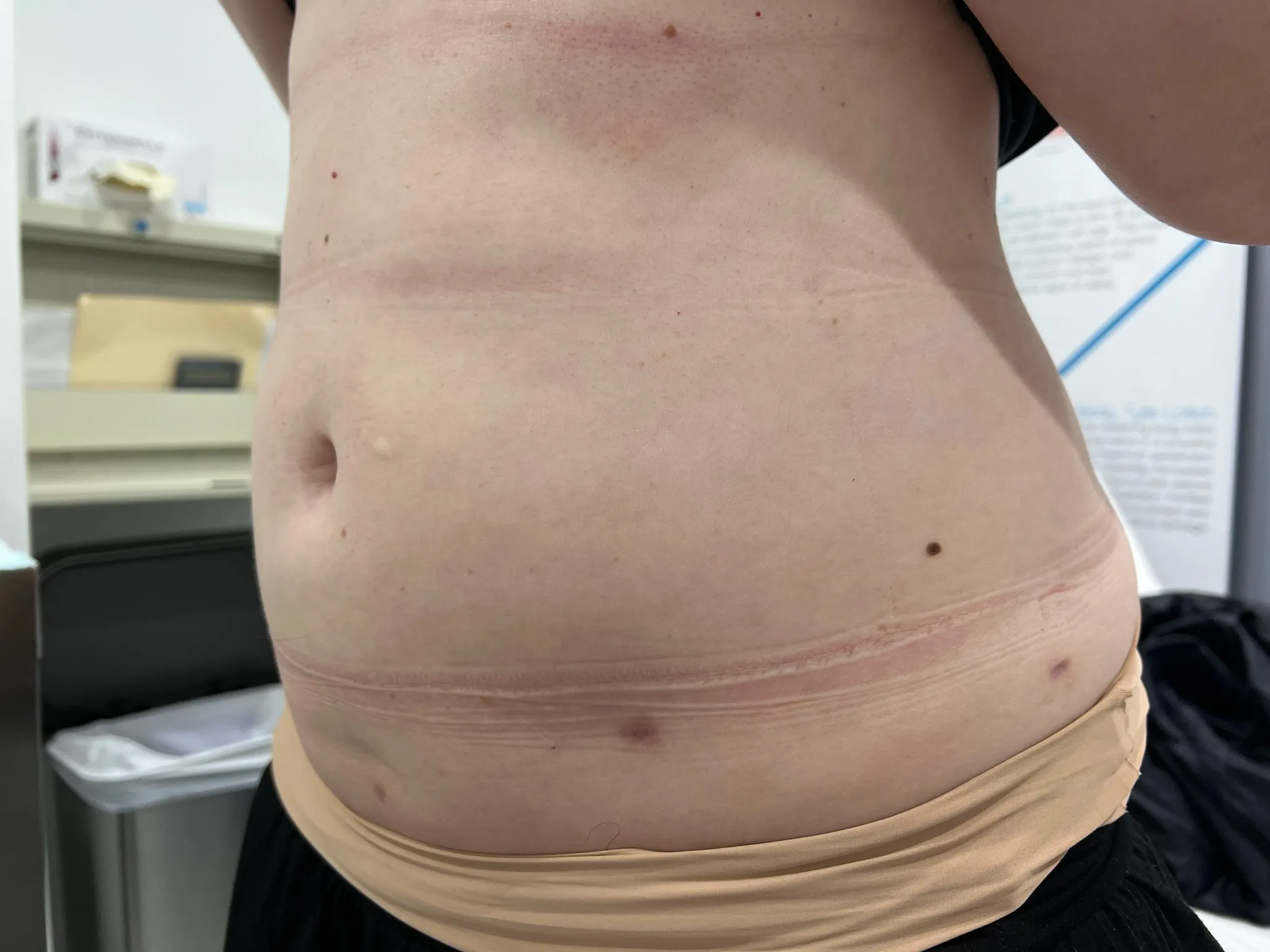 a person's stomach with scar on it | 1aesthetics in Hoboken, NJ and Weehawken, NJ