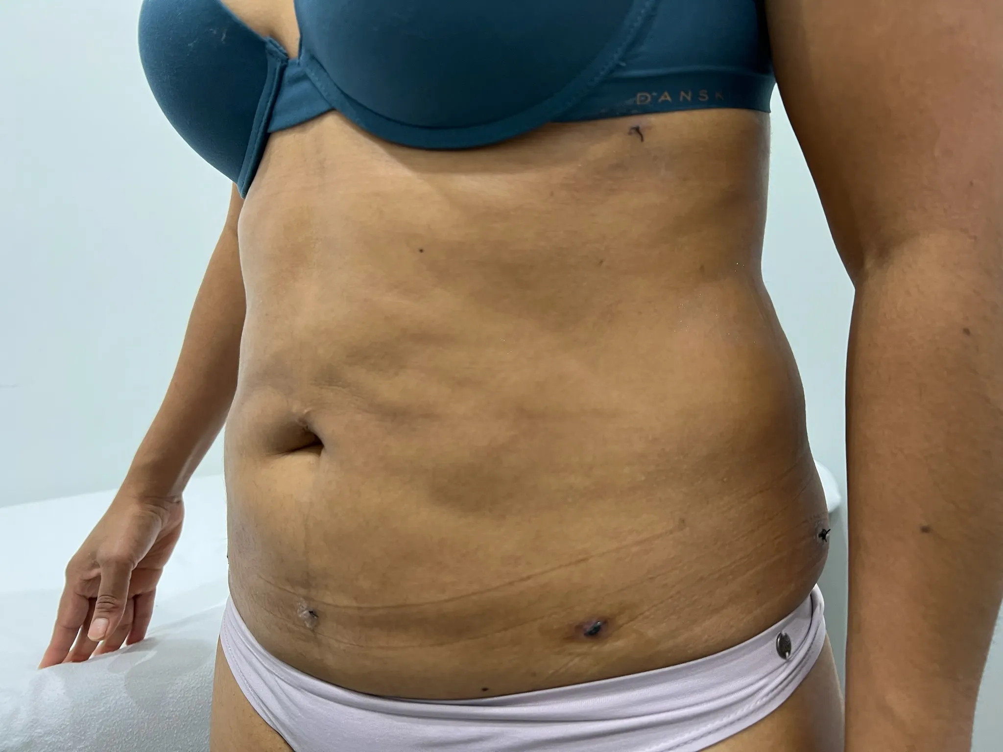 a woman's belly with a few bumps on her stomach | 1aesthetics in Hoboken, NJ and Weehawken, NJ