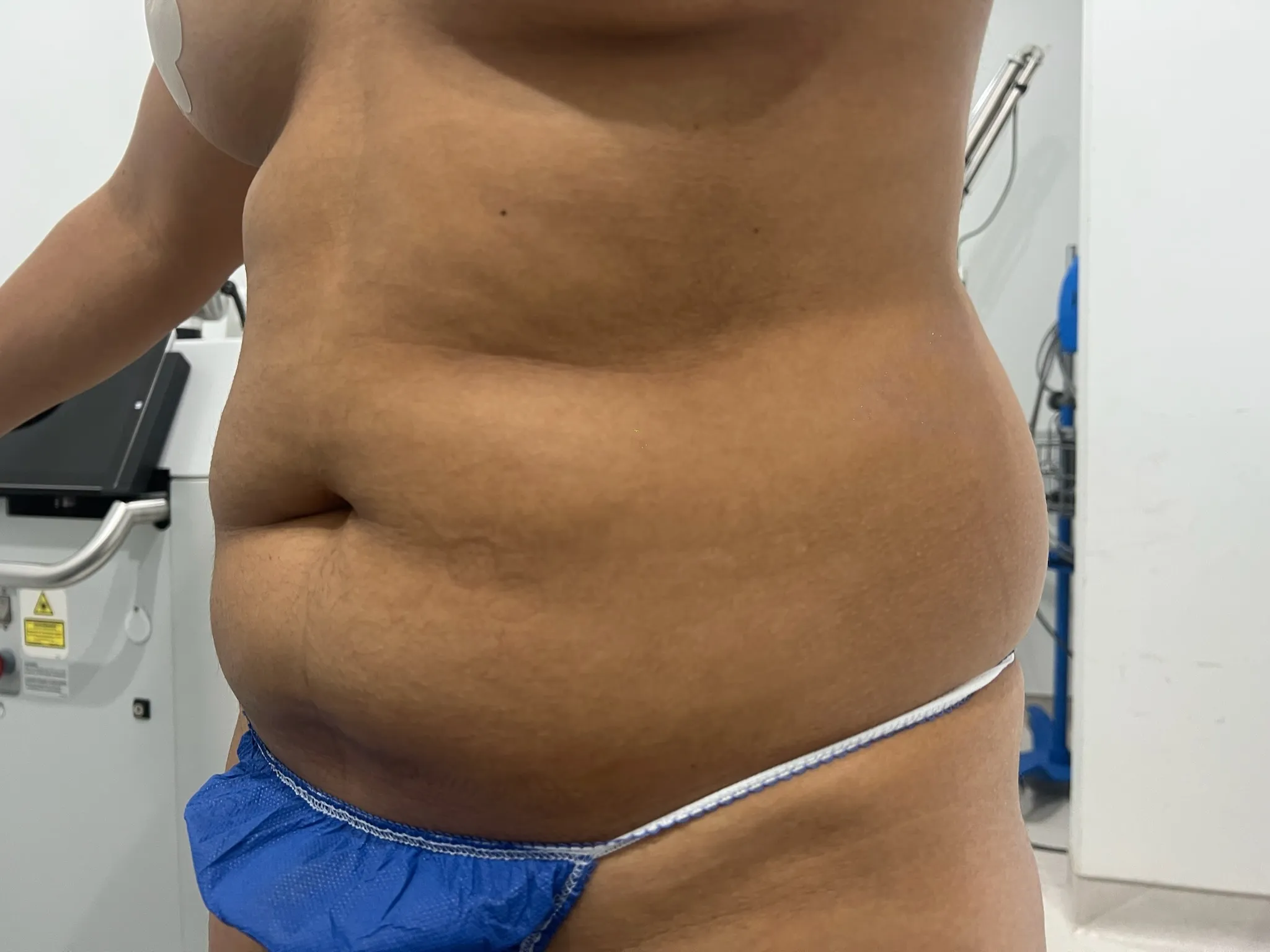 a person's belly with a blue thong | 1aesthetics in Hoboken, NJ and Weehawken, NJ