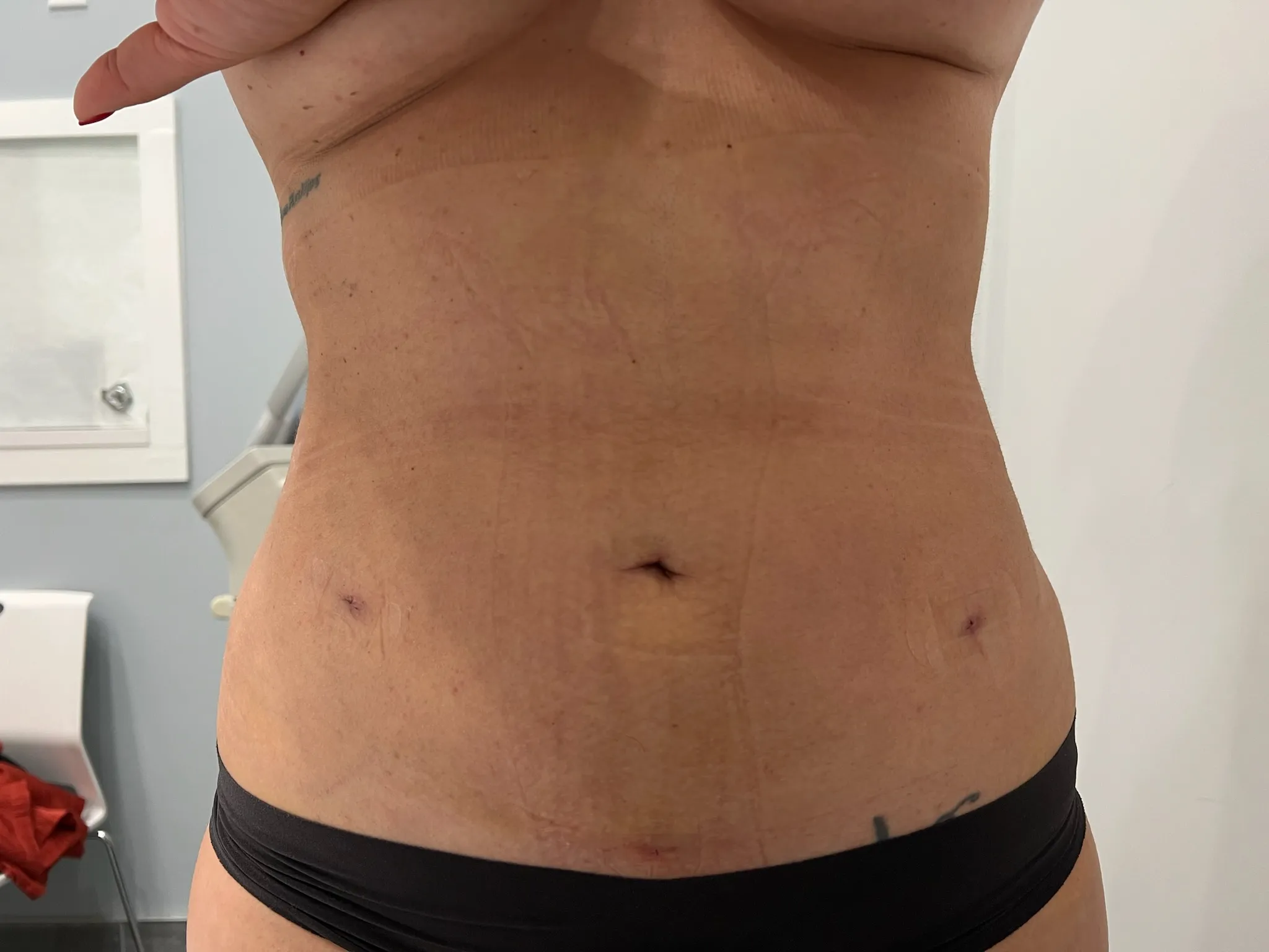 a woman's stomach with scar on her belly | 1aesthetics in Hoboken, NJ and Weehawken, NJ