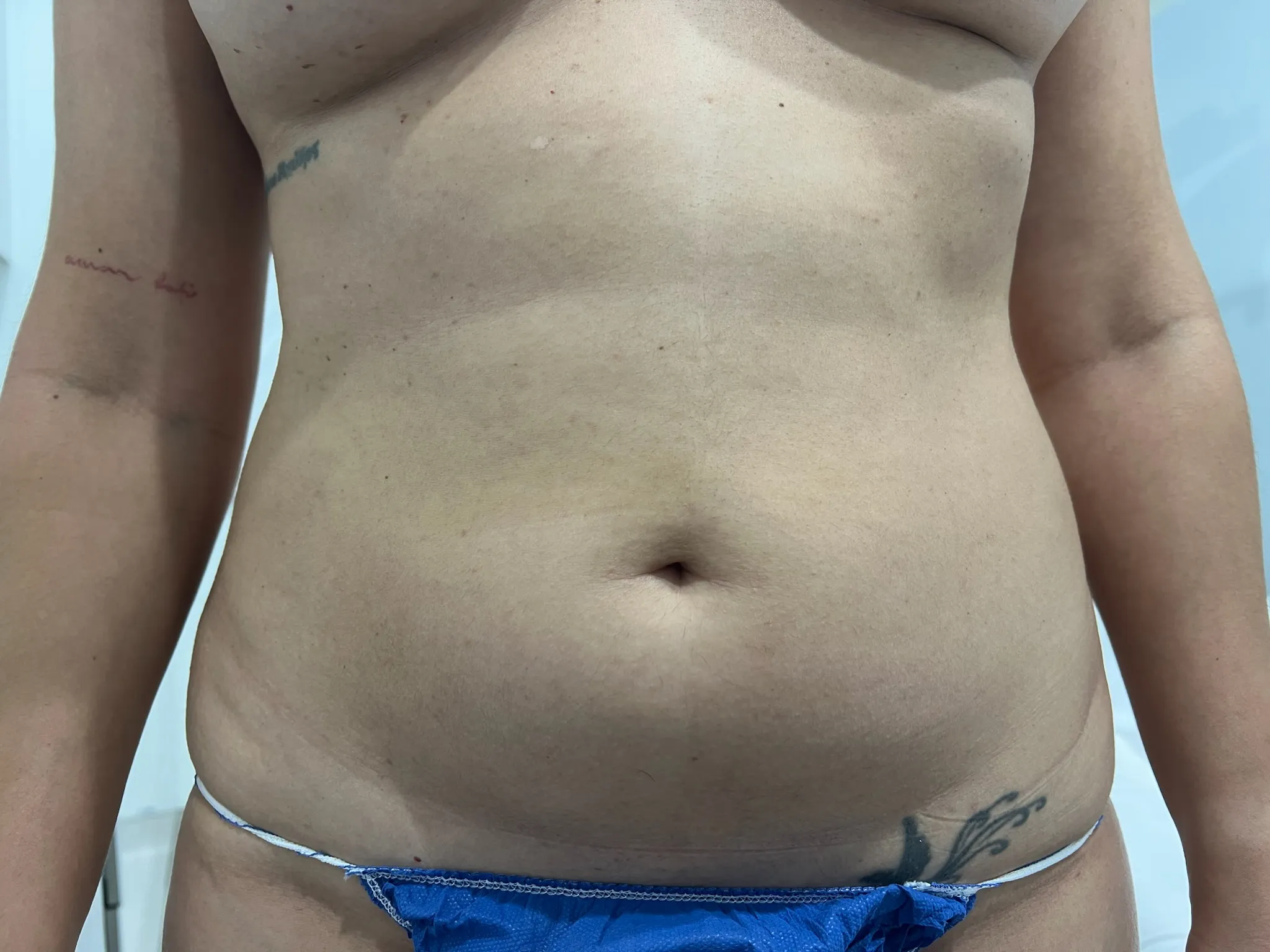 a person's belly button | 1aesthetics in Hoboken, NJ and Weehawken, NJ