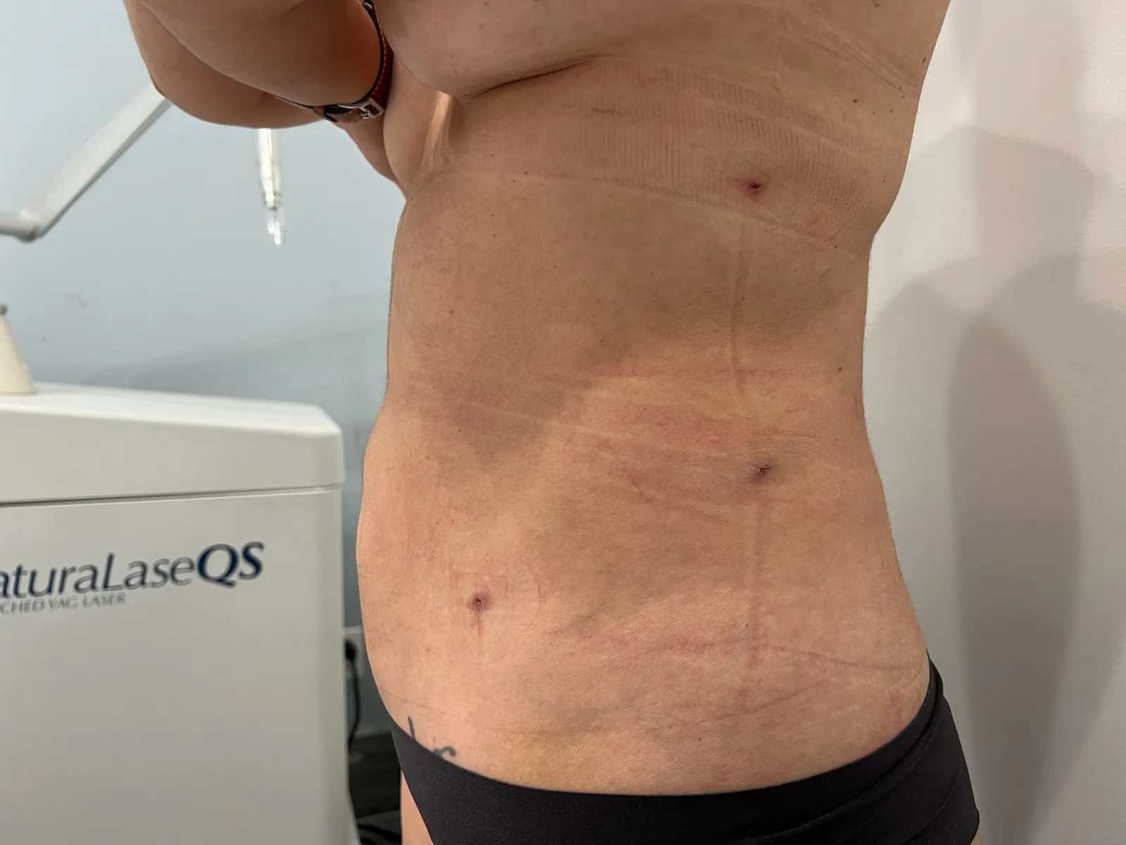 a person's stomach with scar | 1aesthetics in Hoboken, NJ and Weehawken, NJ