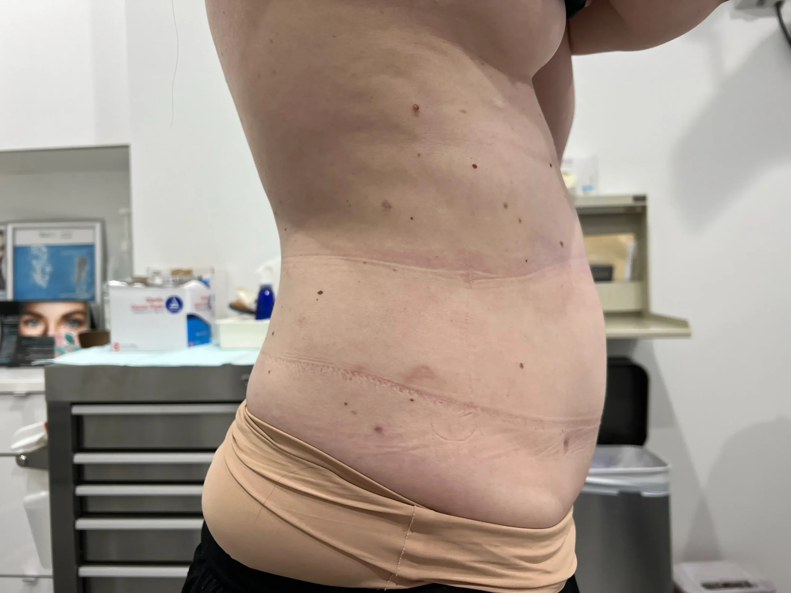 a person's stomach with scar | 1aesthetics in Hoboken, NJ and Weehawken, NJ