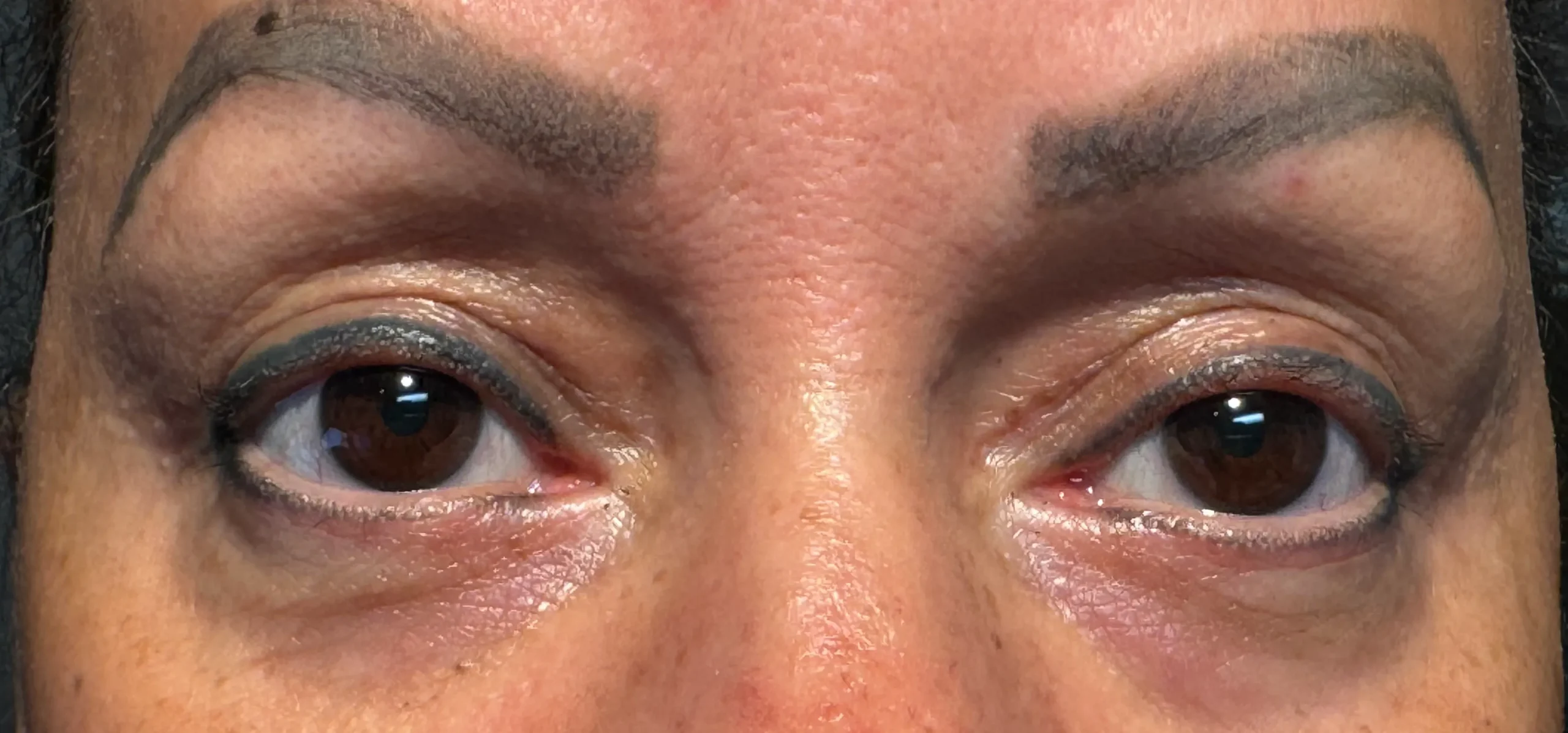 After Blepharoplasty Treatment in Hoboken, NJ and Weehawken, NJ