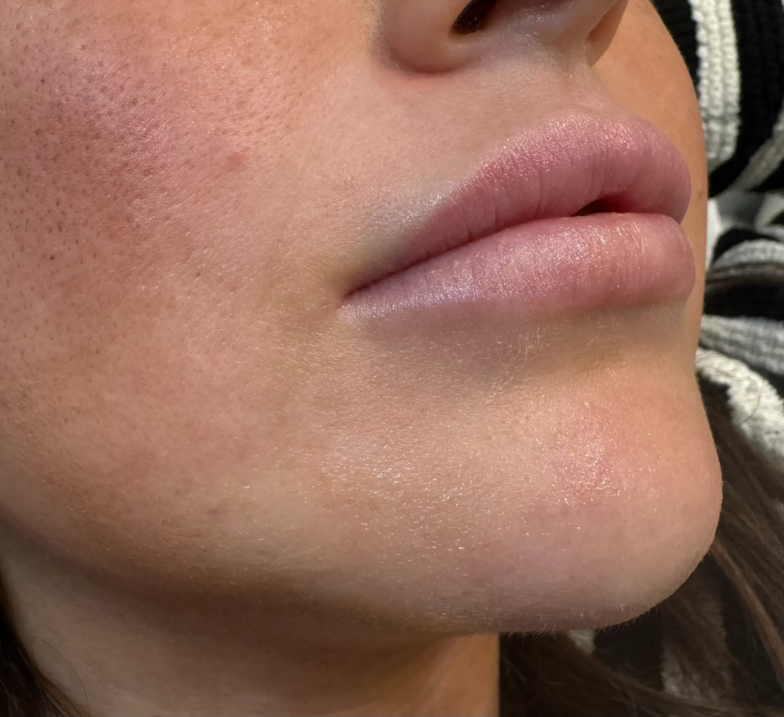 Chin Filler Treatment in Hoboken, NJ and Weehawken, NJ