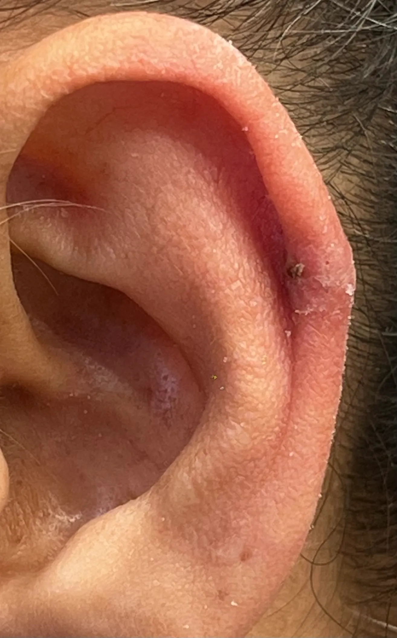 After Earlobe Repair in Hoboken, NJ and Weehawken, NJ