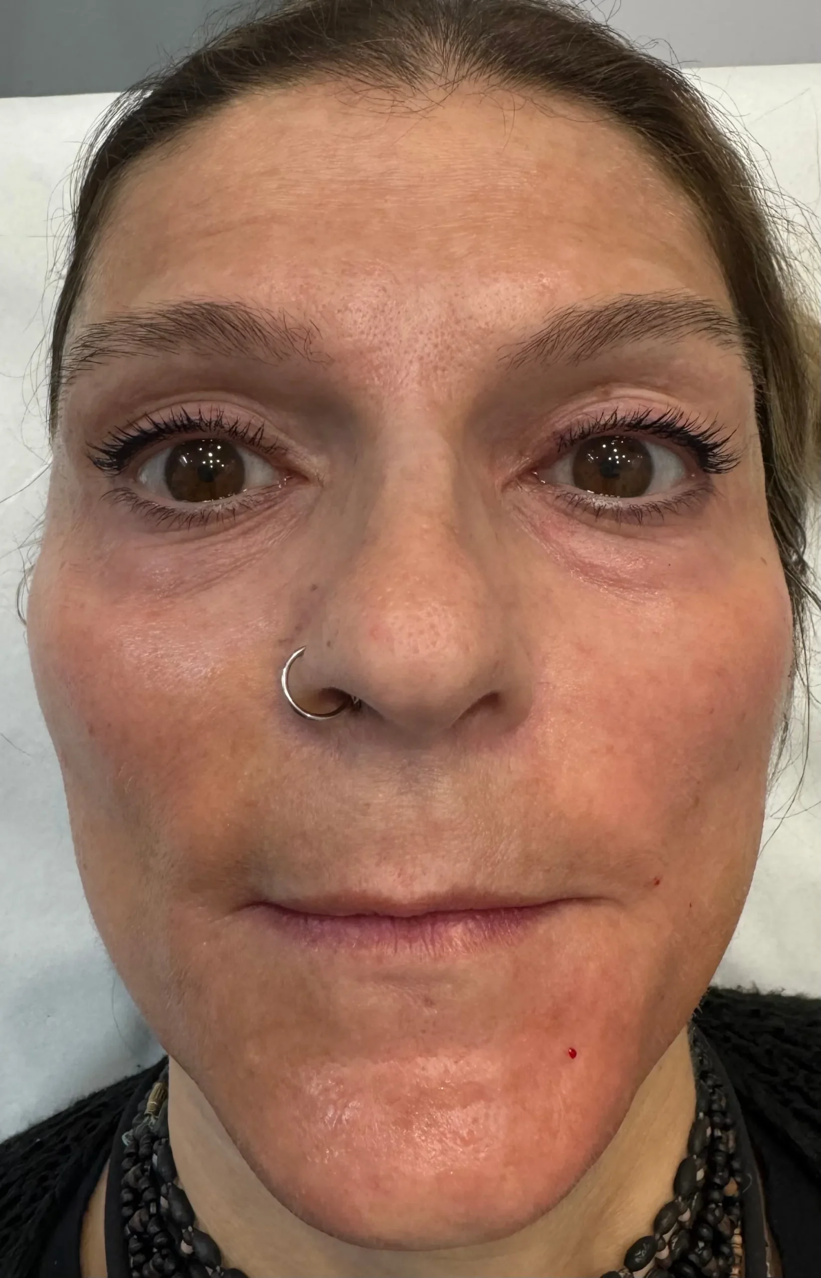 After Sculptra Treatment in Hoboken, NJ and Weehawken, NJ