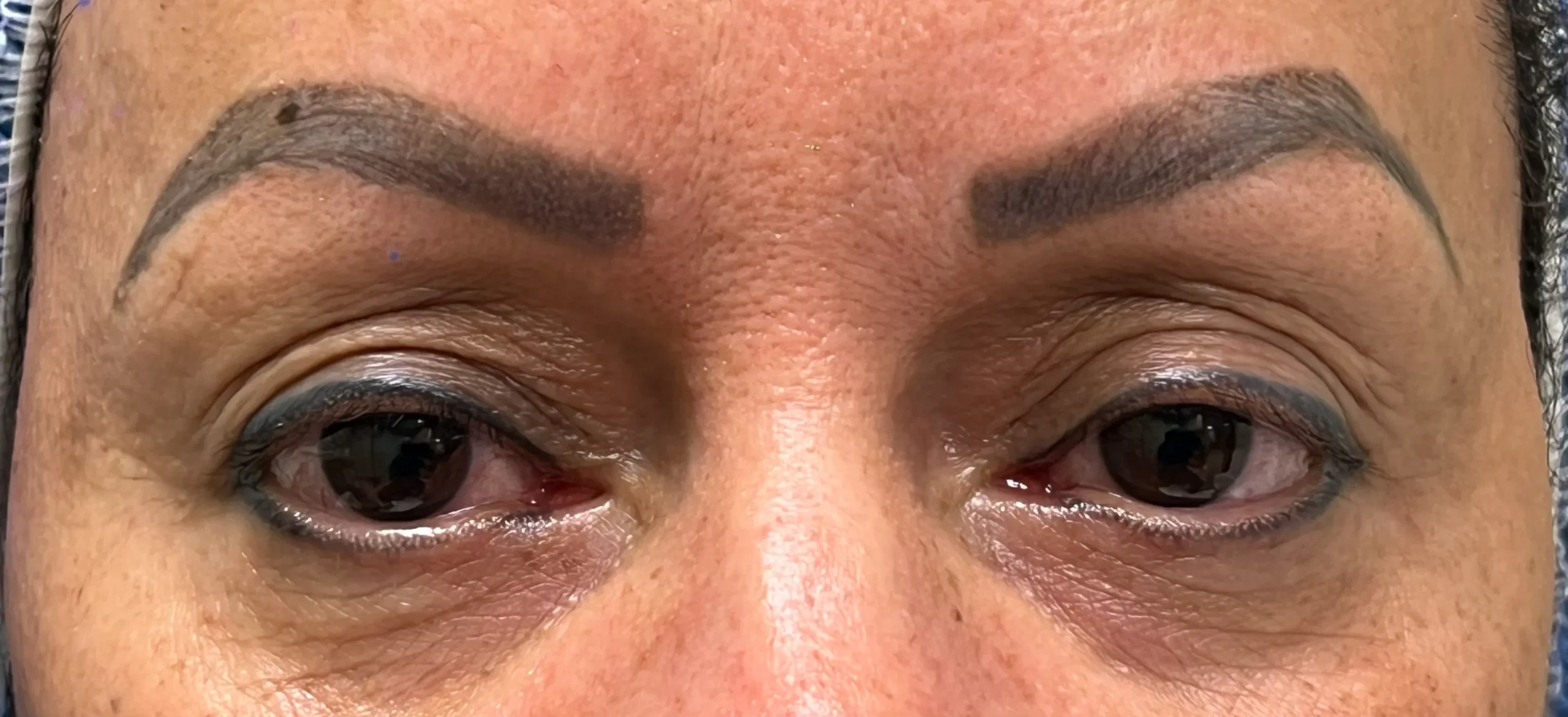 Before Blepharoplasty Treatment in Hoboken, NJ and Weehawken, NJ