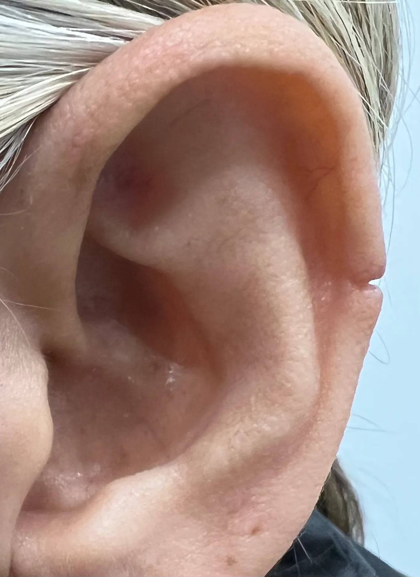 Before EarLobe Repair in Hoboken, NJ and Weehawken, NJ