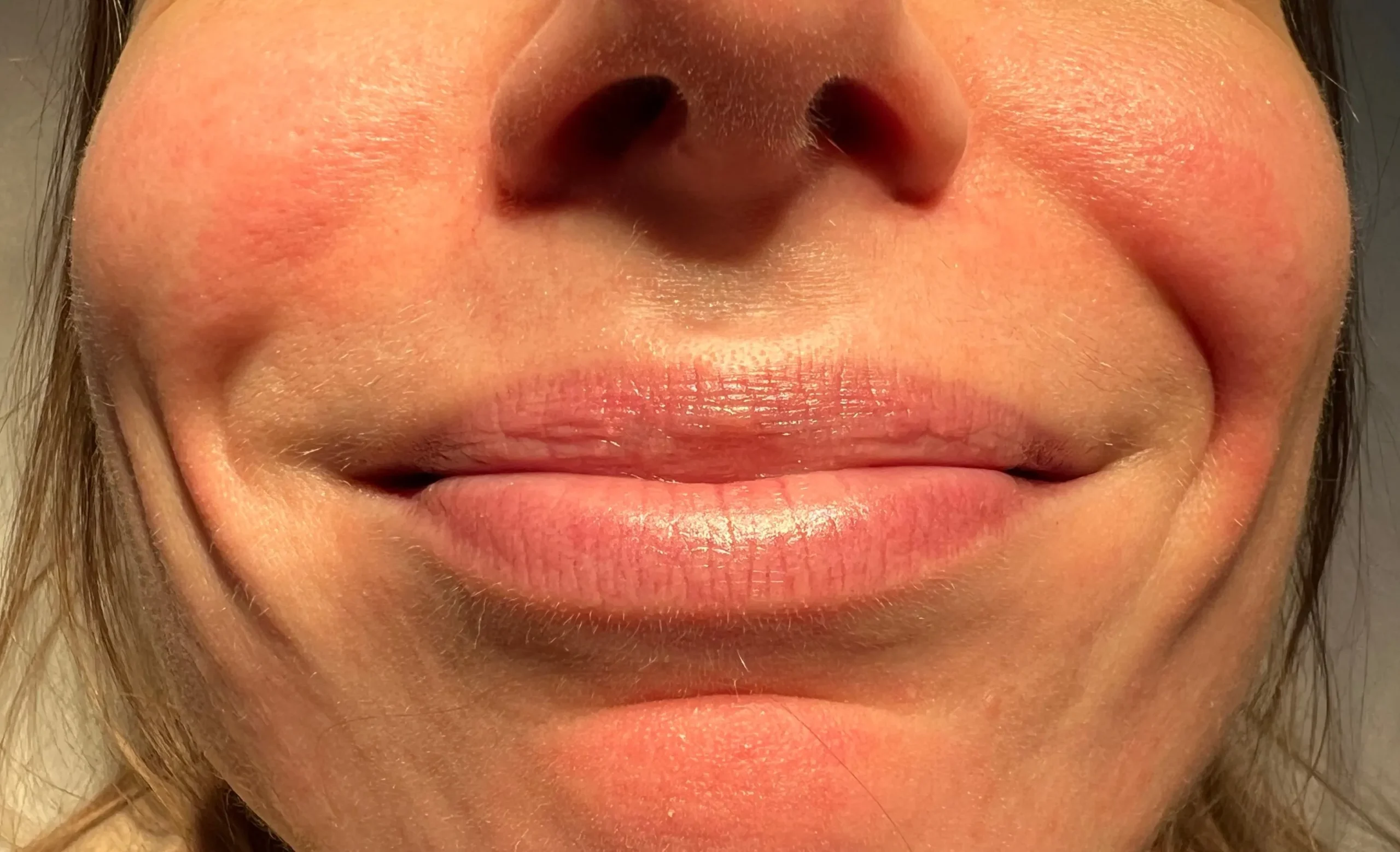 Before Smile Line Treatment in Hoboken, NJ and Weehawken, NJ