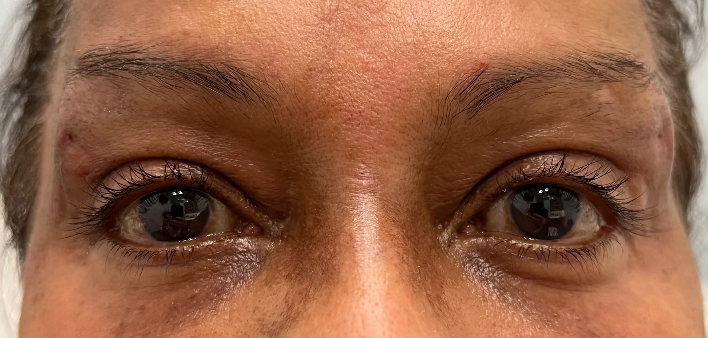 Brow Thread Lift After Before in Hoboken, NJ and Weehawken, NJ