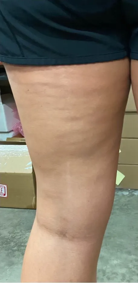 Carbon Wave Cellulite Treatment Before After3 in Hoboken, NJ and Weehawken, NJ