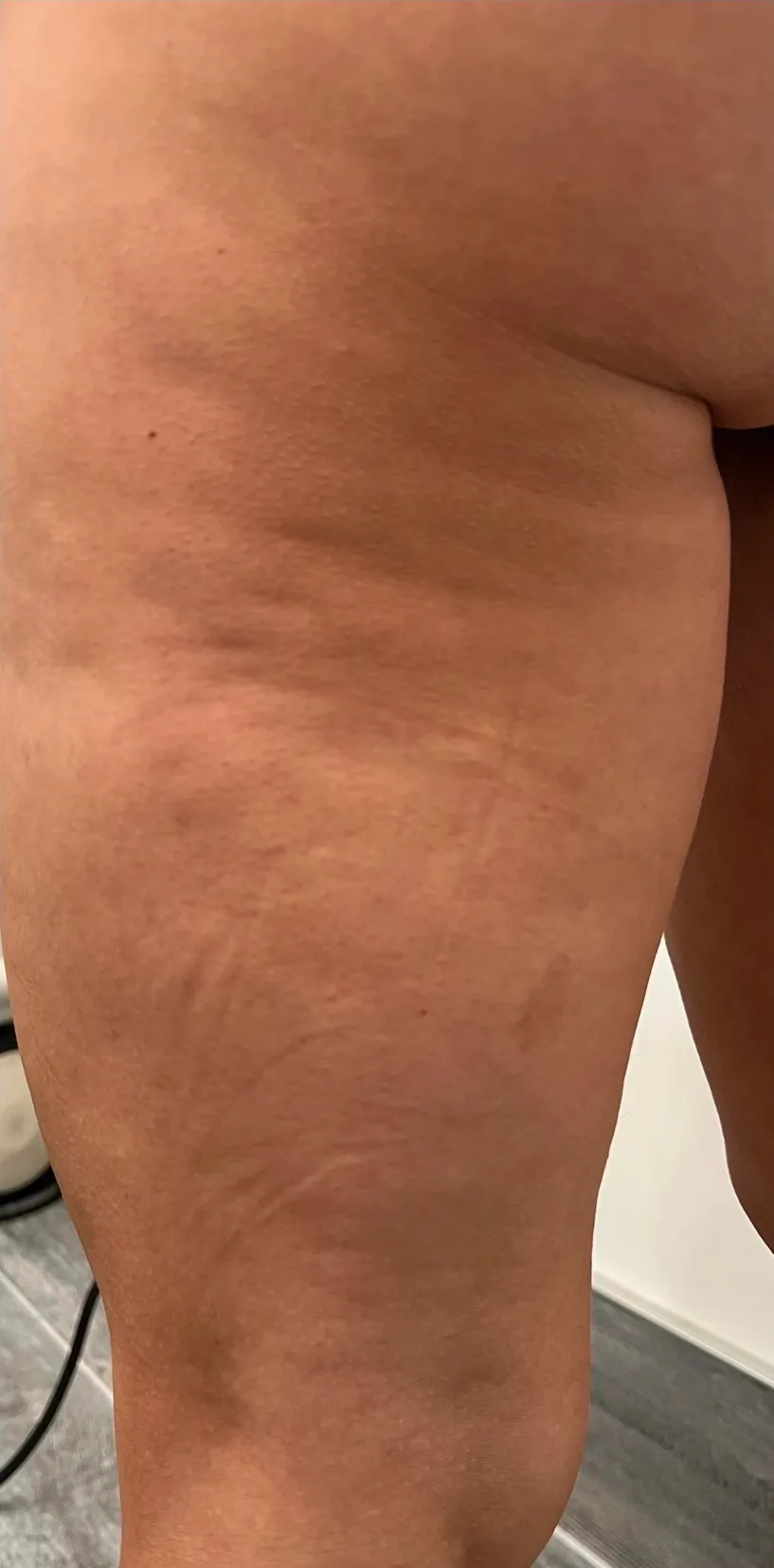 Carbon Wave Cellulite Treatment Before After1 in Hoboken, NJ and Weehawken, NJ