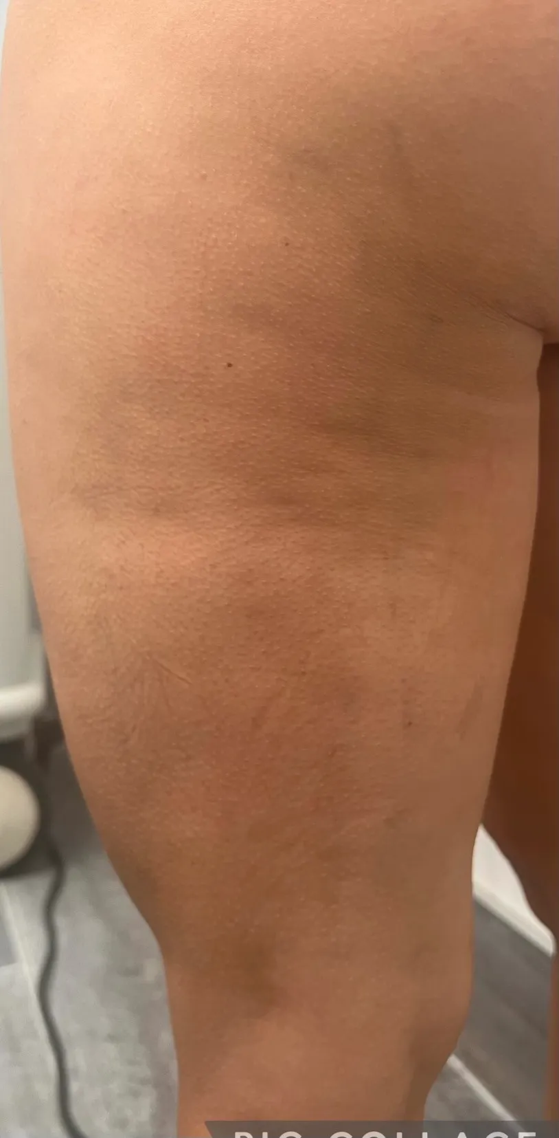 Carbon Wave Cellulite Treatment Before After in Hoboken, NJ and Weehawken, NJ