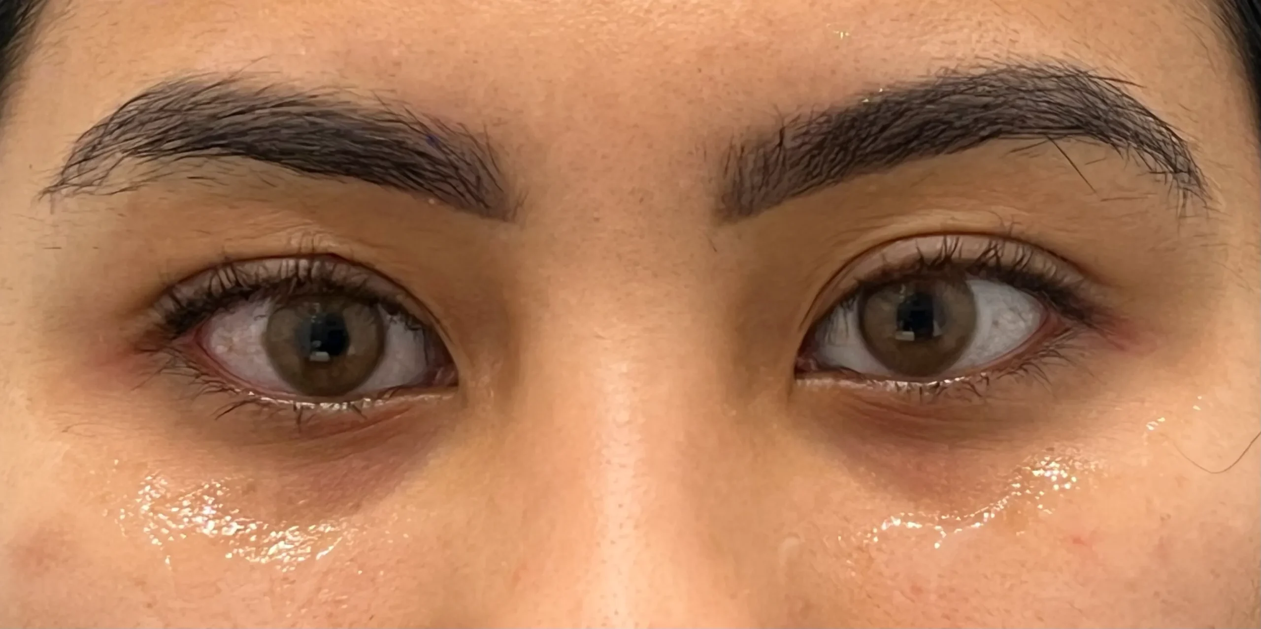 Eyelid/Tear Trough Filler Treatment in Hoboken, NJ and Weehawken, NJ