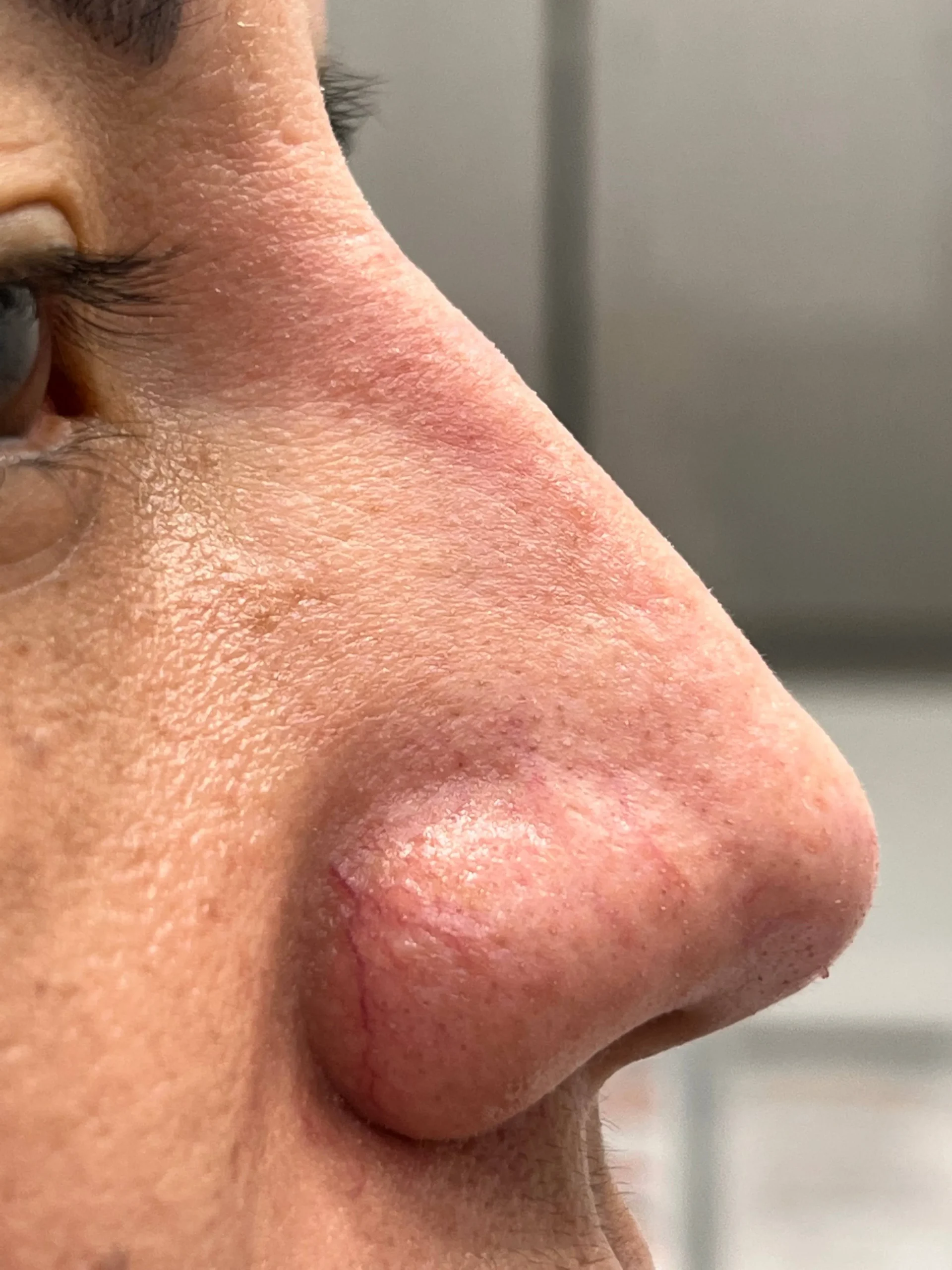 Liquid Nose Job Treatment After in Hoboken, NJ and Weehawken, NJ