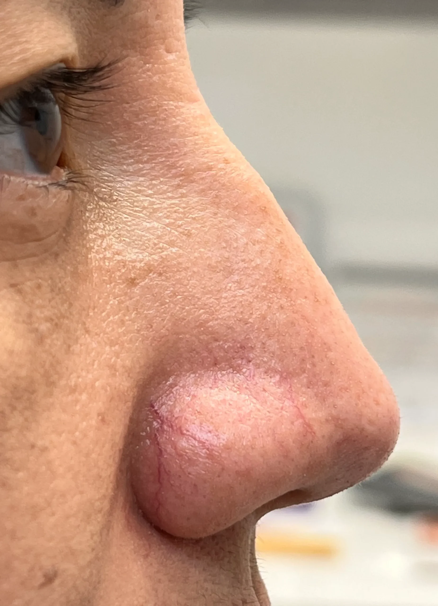 Liquid Nose Job Treatment Before in Hoboken, NJ and Weehawken, NJ