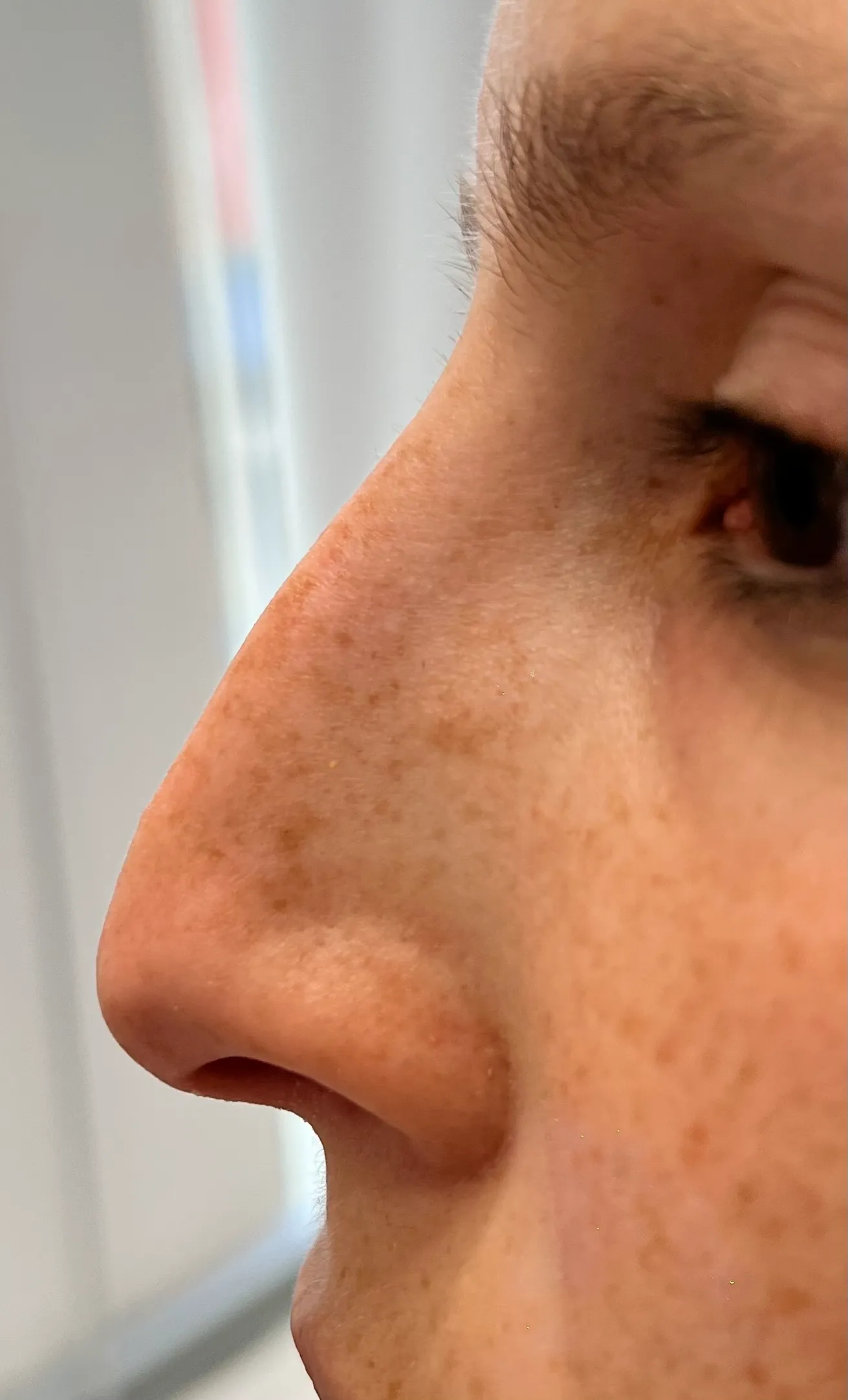 Liquid Nose Job Treatment Before in Hoboken, NJ and Weehawken, NJ