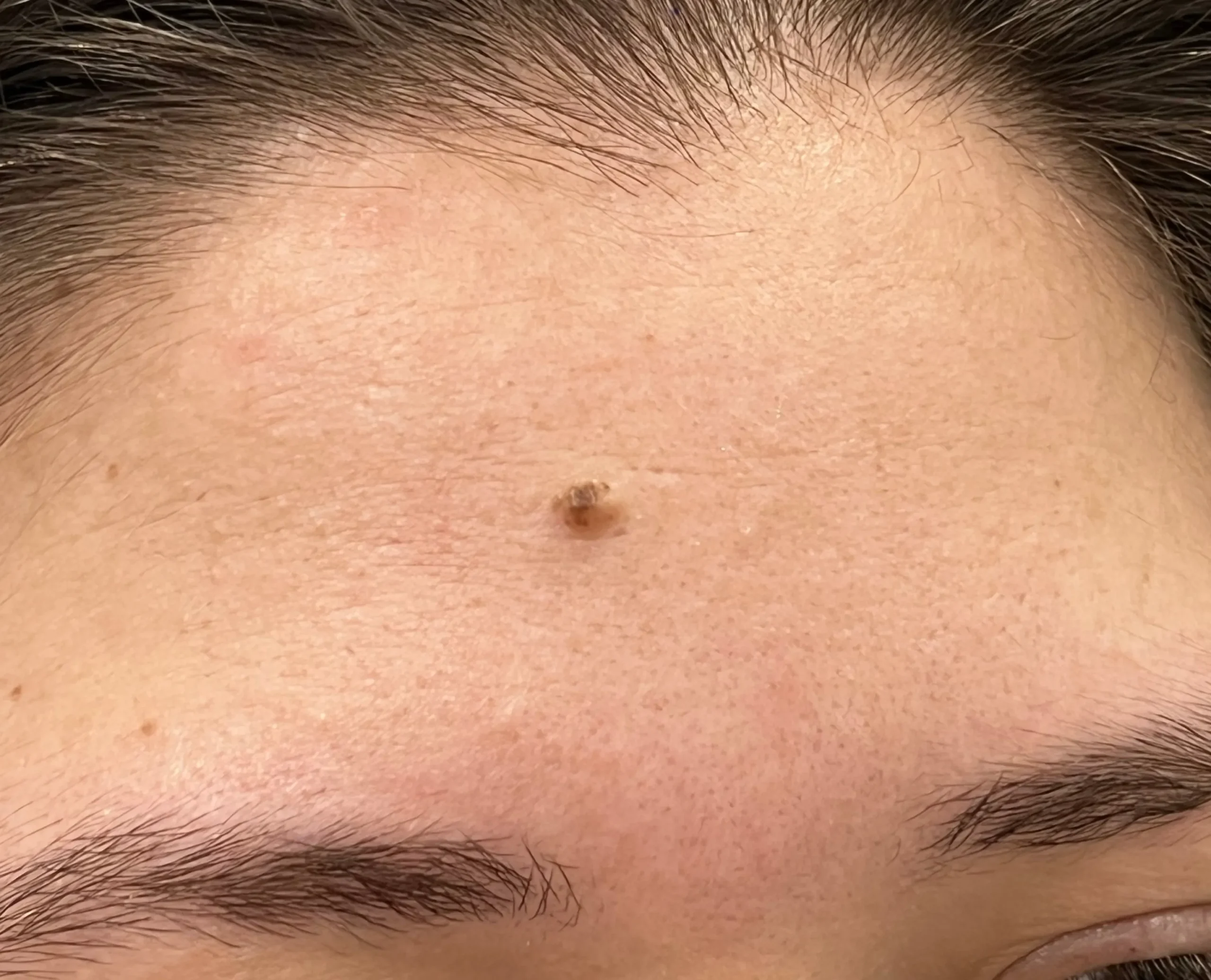 Mole Removal Before Treatment in Hoboken, NJ and Weehawken, NJ