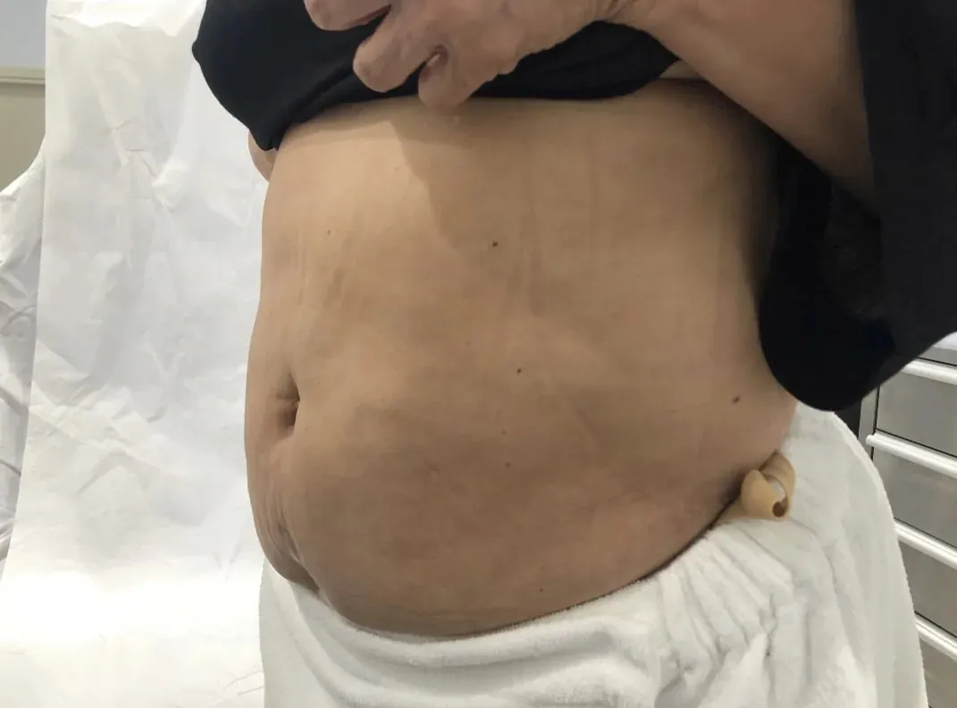 Liposuction Before After in Hoboken, NJ and Weehawken, NJ