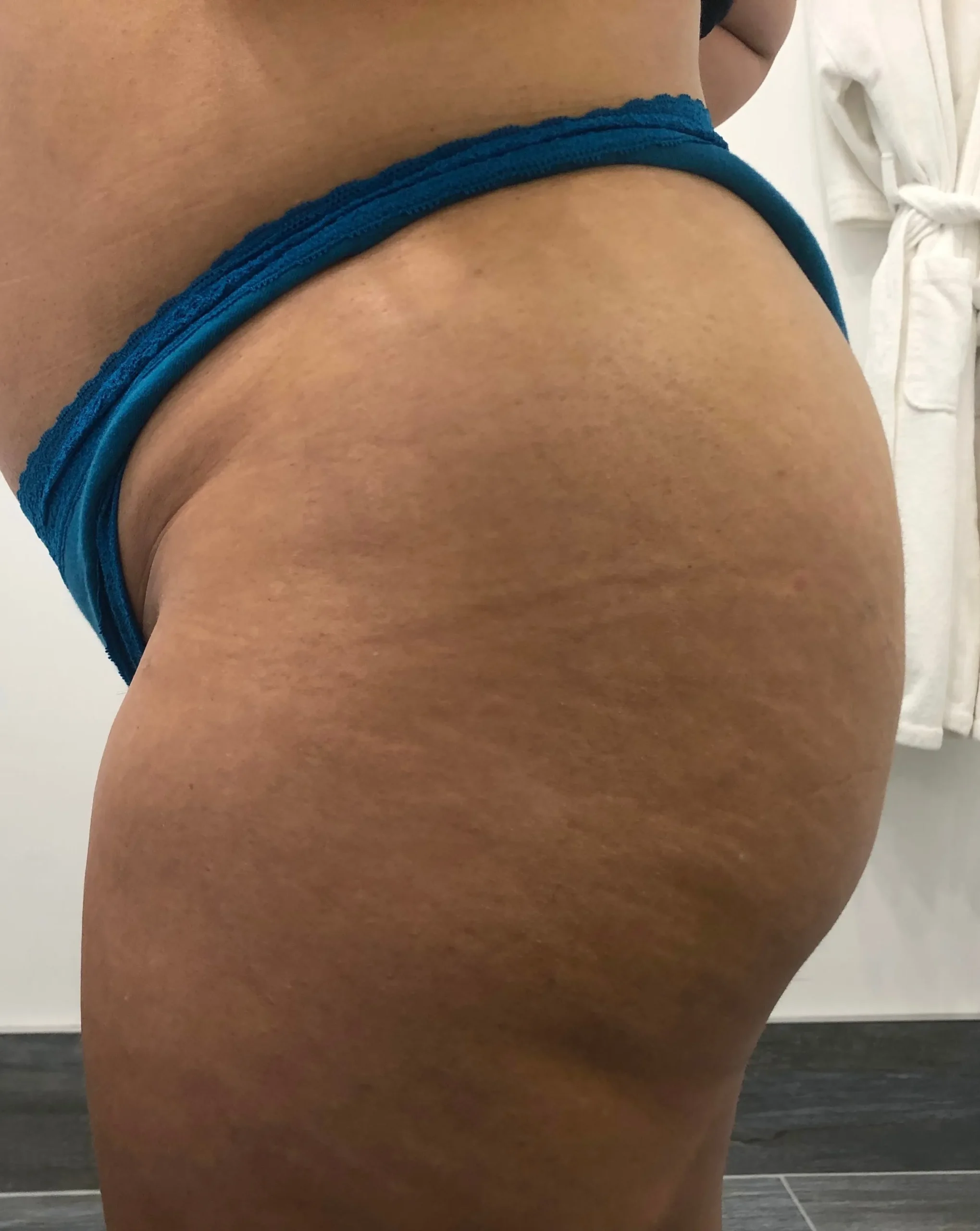 Sculptra Butt Lift After Treatment in Hoboken, NJ and Weehawken, NJ