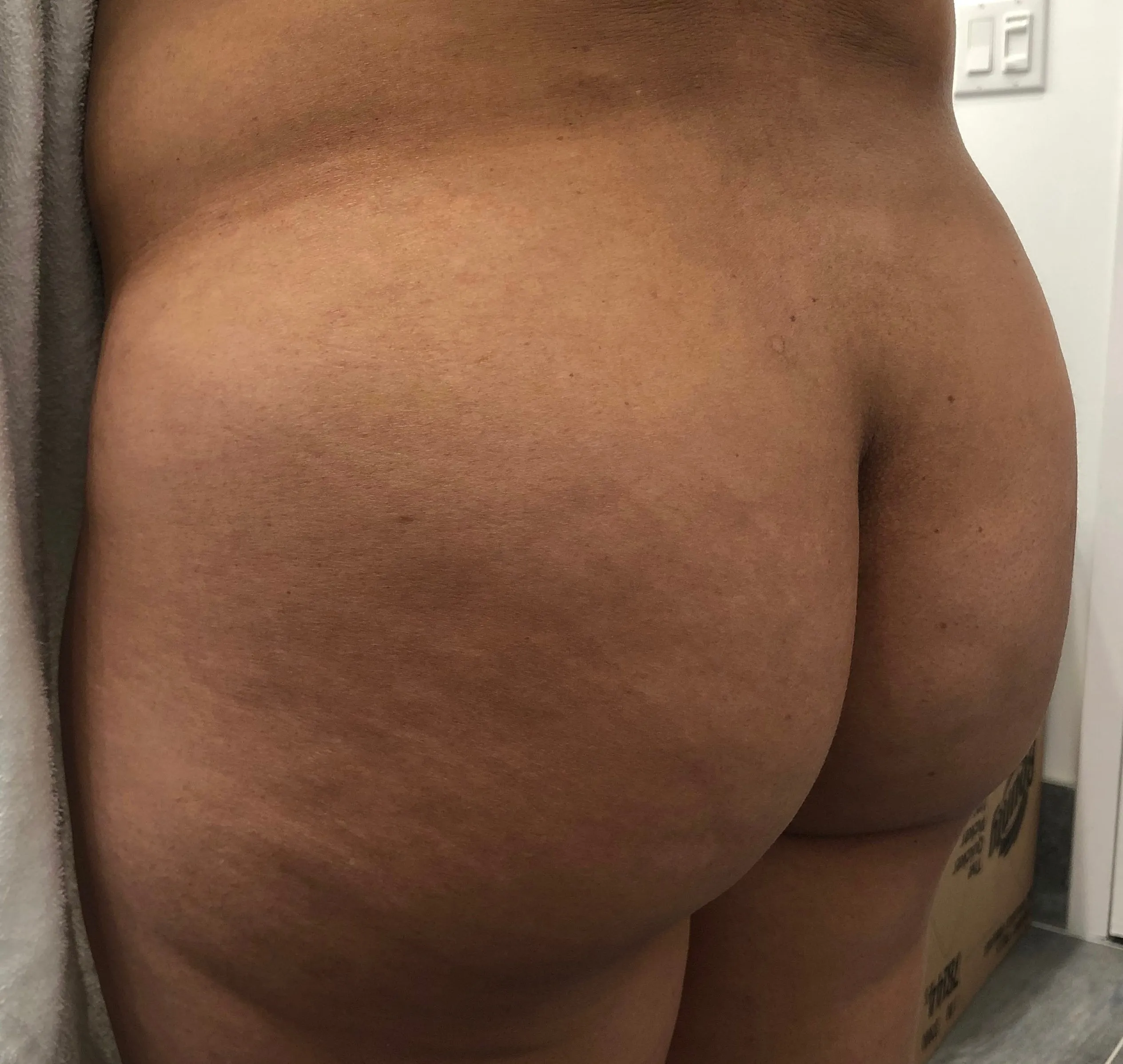 Sculptra Butt Lift Before Treatment in Hoboken, NJ and Weehawken, NJ