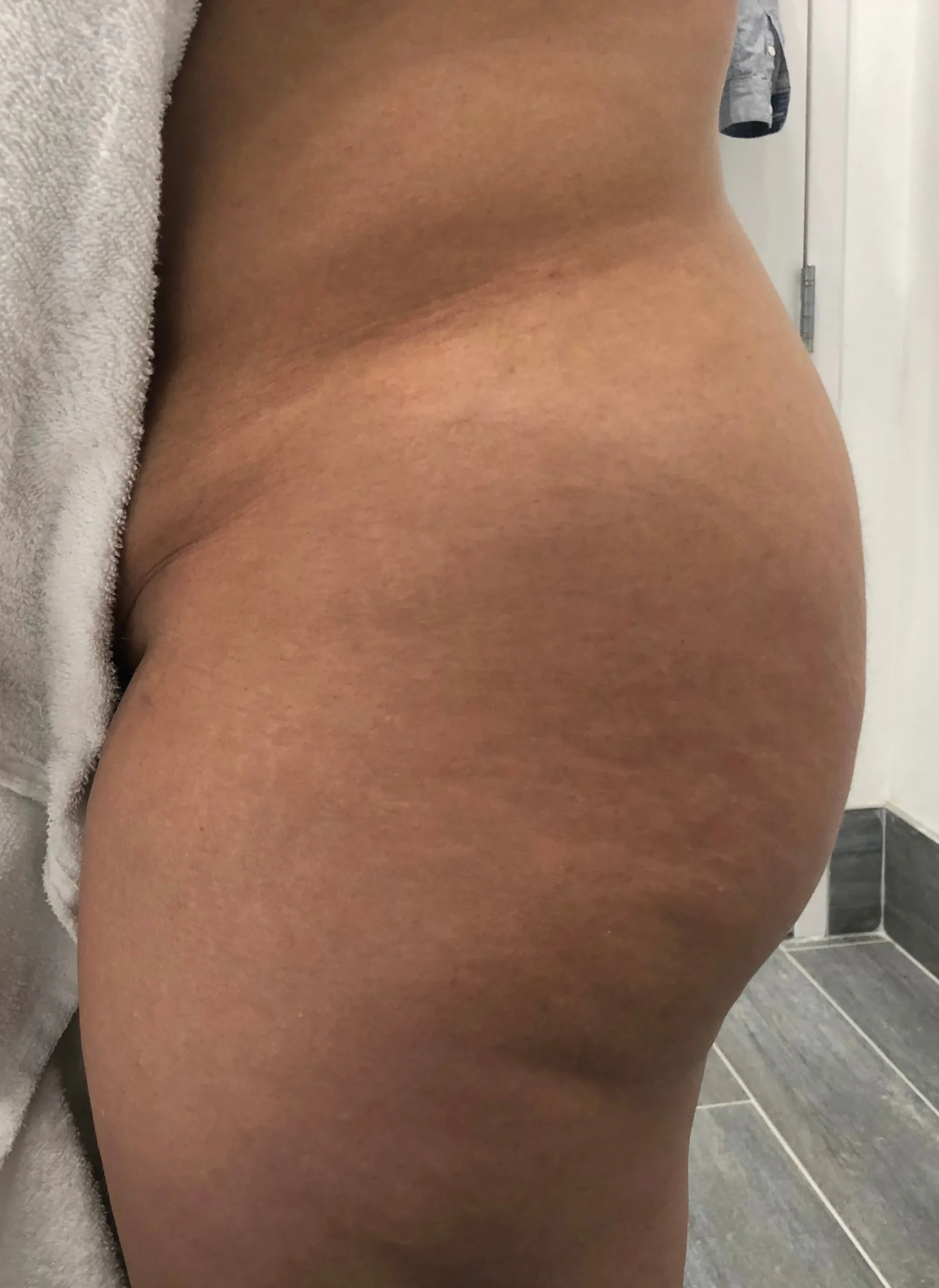 Sculptra Butt Lift Before Treatment in Hoboken, NJ and Weehawken, NJ