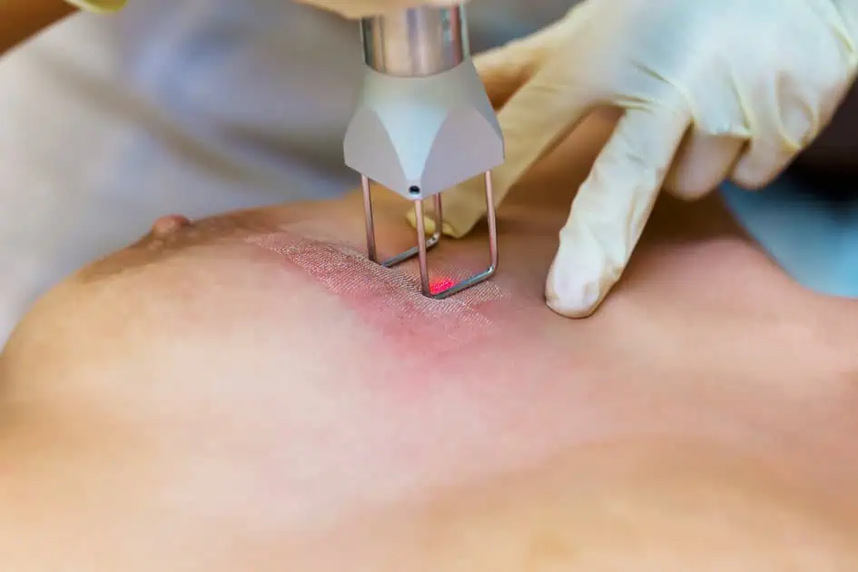 Stretch Mark Laser Therapy by Edgewater Cosmetic Center in Hoboken, NJ