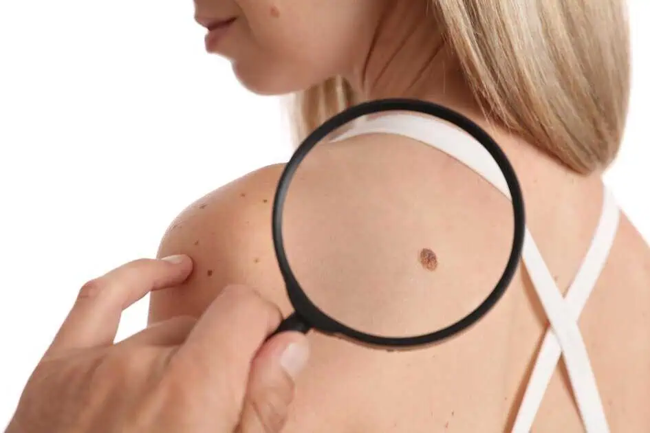 Birthmark Removal in Hoboken, NJ by Edgewater Cosmetic Center