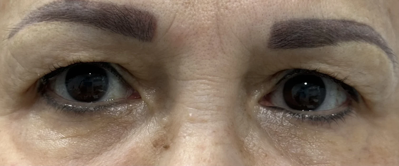 Before Blepharoplasty Treatment | Hoboken and Weehawken NJ | 1Aesthetic