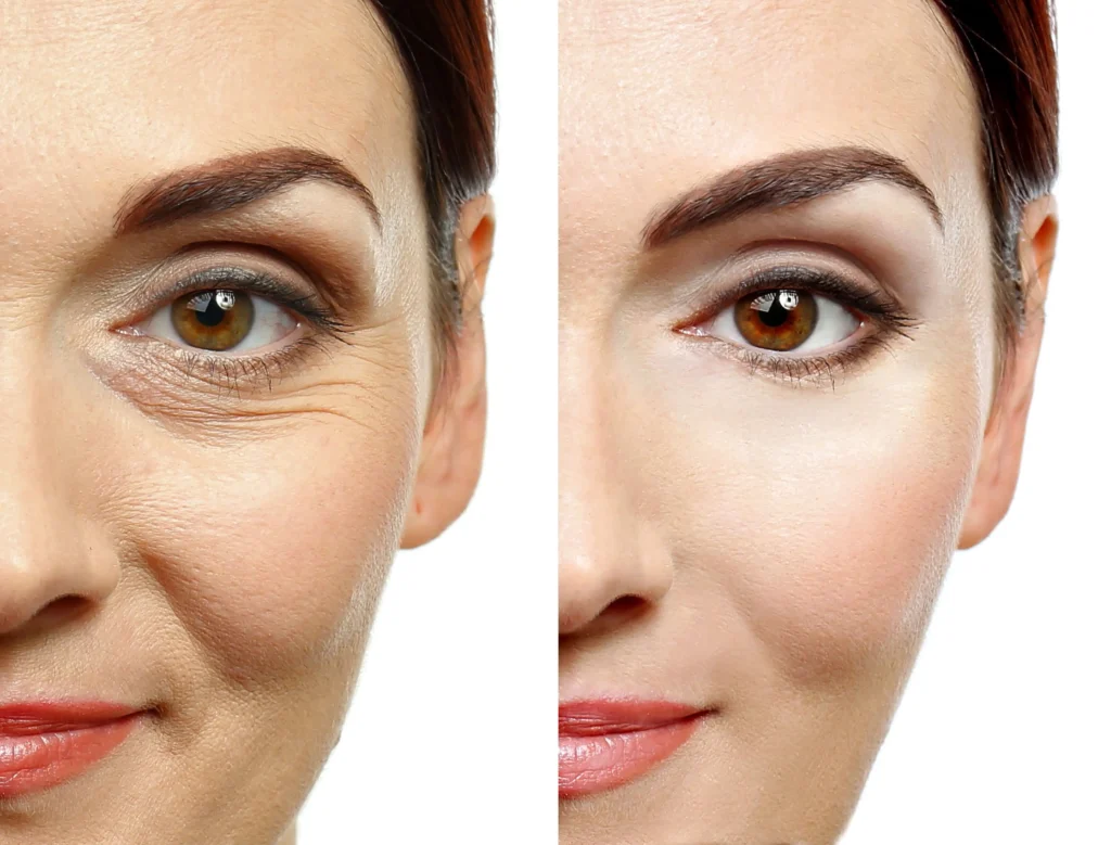 Botox after and after treatment - 1aesthetic