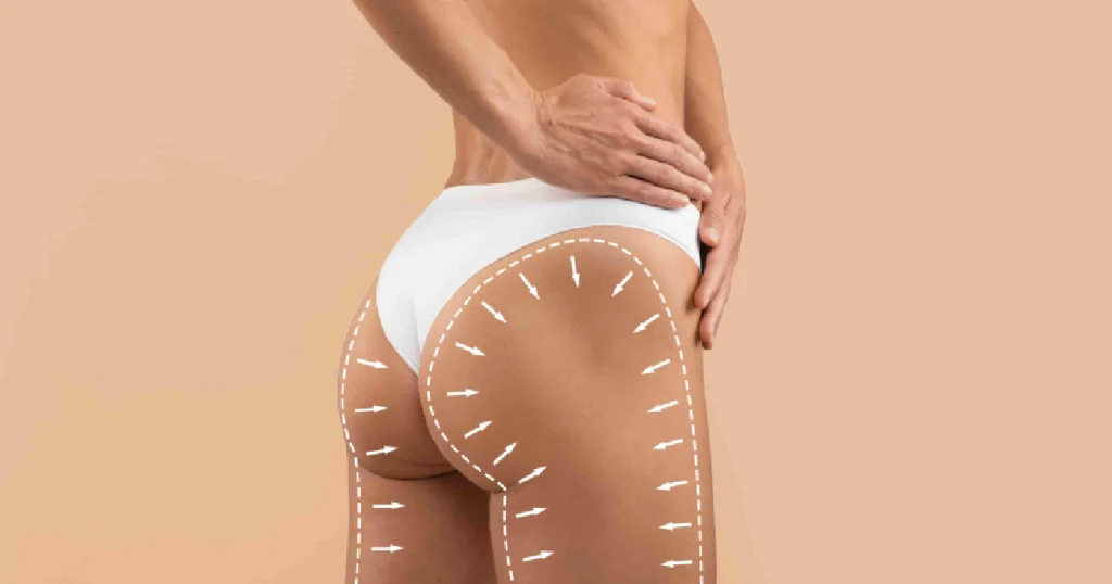 Close-up of woman’s lower body in white underwear with surgical markings, illustrating Brazilian Butt Lift procedure for natural enhancement in Hoboken, NJ and Weehawken, NJ