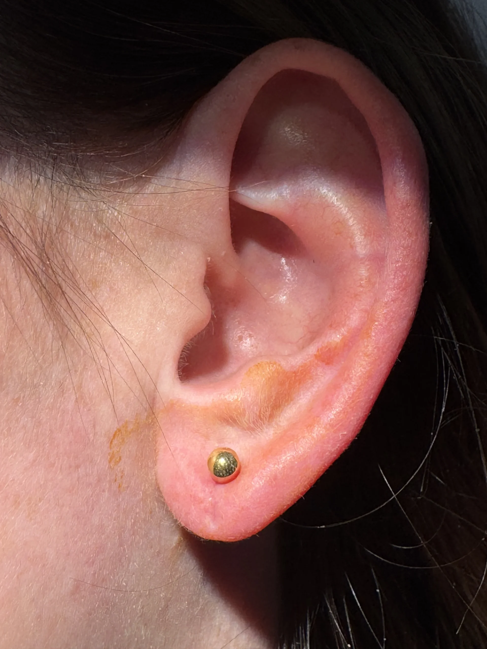 Earlobe repair after treatment in Hoboken, NJ, and Weehawken, NJ | 1Aesthetic
