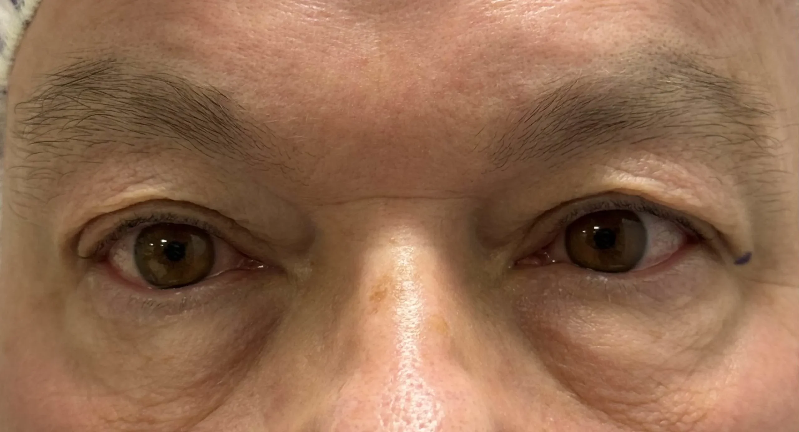 Before Blepharoplasty Treatment in Hoboken, NJ, and Weehawken, NJ | 1Aesthetic